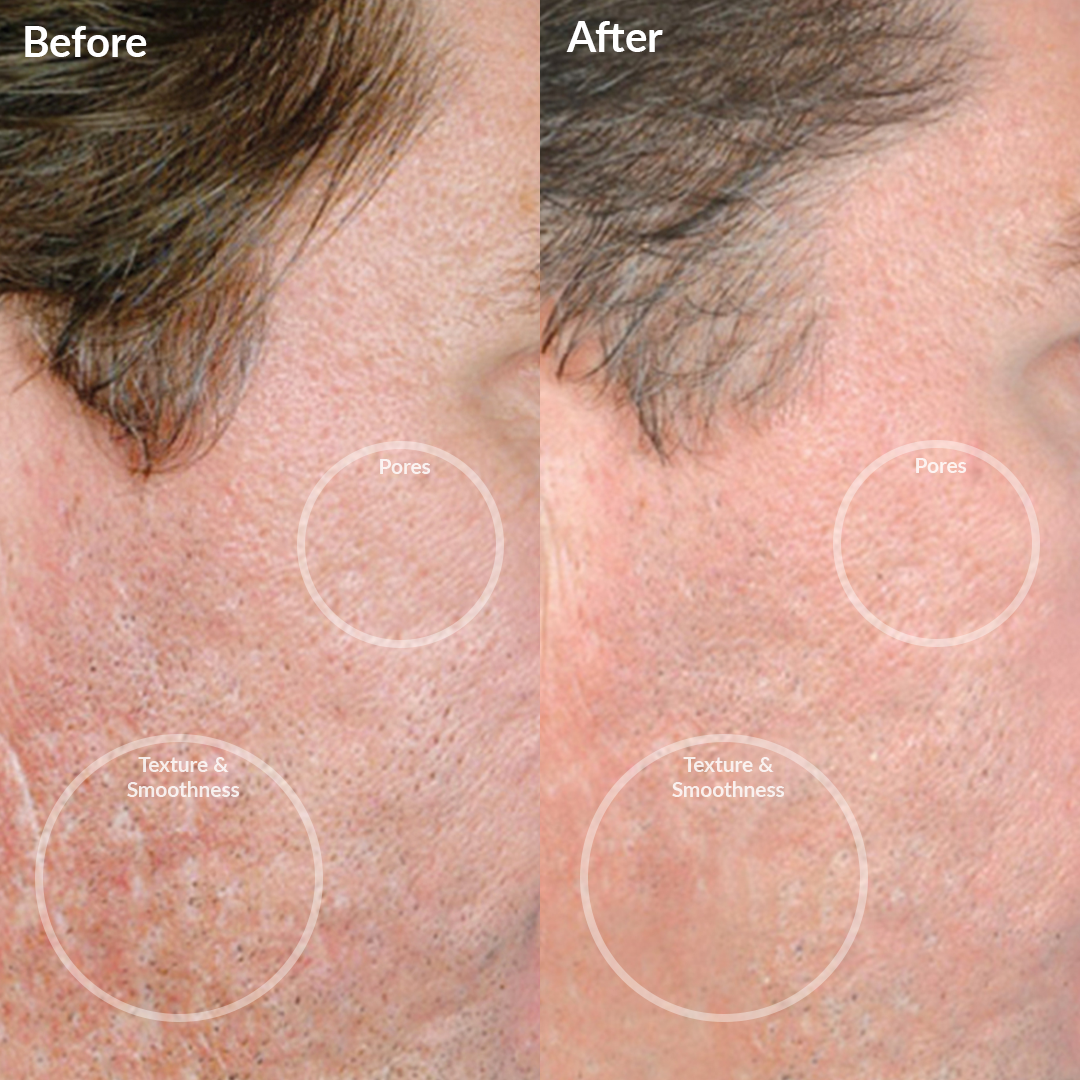 Personal Microderm Pro - Black